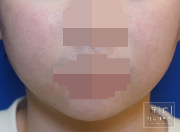 [목동점] 얼굴좁쌀여드름 치료 후 사진 - 해율한의원